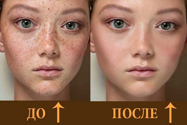 Уберу пигментные пятна, веснушки, родинки
